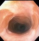 MULTIPLE ESOPHAGEAL INLET PATCHES