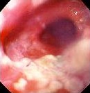 BARRETT ESOPHAGUS - CARCINOMA