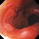 BARRETT'S ESOPHAGUS DYPLASIA