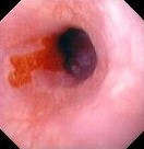 SHORT BARRETT'S ESOPHAGUS