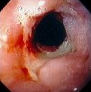 BARRETT ESOPHAGUS ULCER