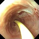 FEEDING TUBE ESOPHAGITIS
