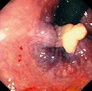 ESOPHAGEAL FIBROEPITHELIAL POLYP