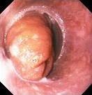 GASTROESOPHAGEAL INTUSCUSSEPTION