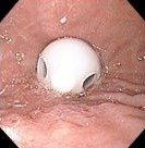 GASTROSTOMY TUBE