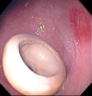 GASTROSTOMY TUBE ULCER