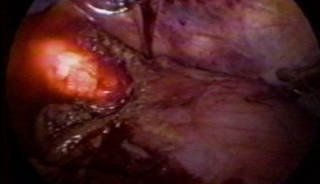 HELLER'S MYOTOMY