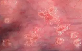 HERPES ESOPHAGITIS