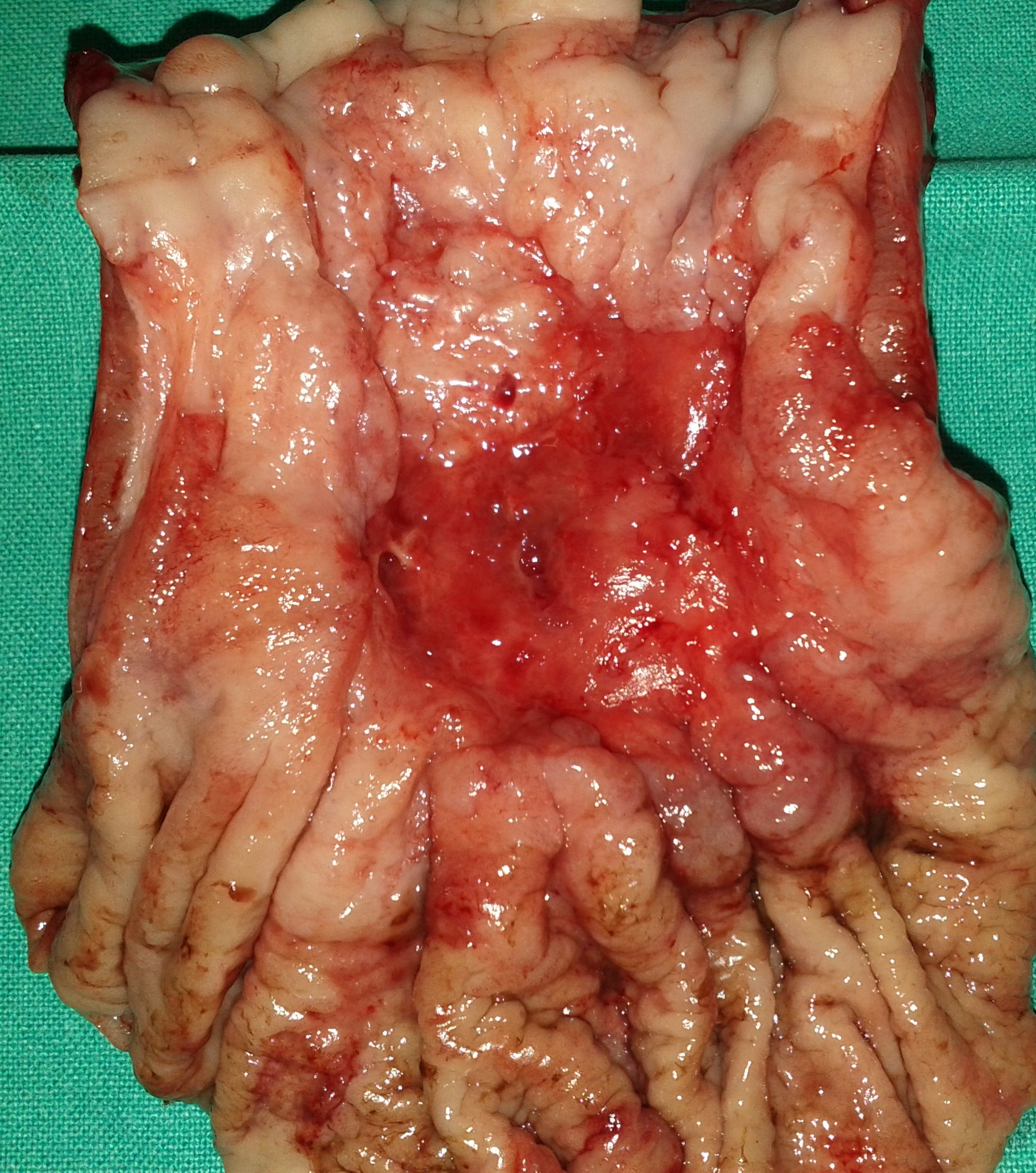 ESOPHAGEAL CARCINOMA