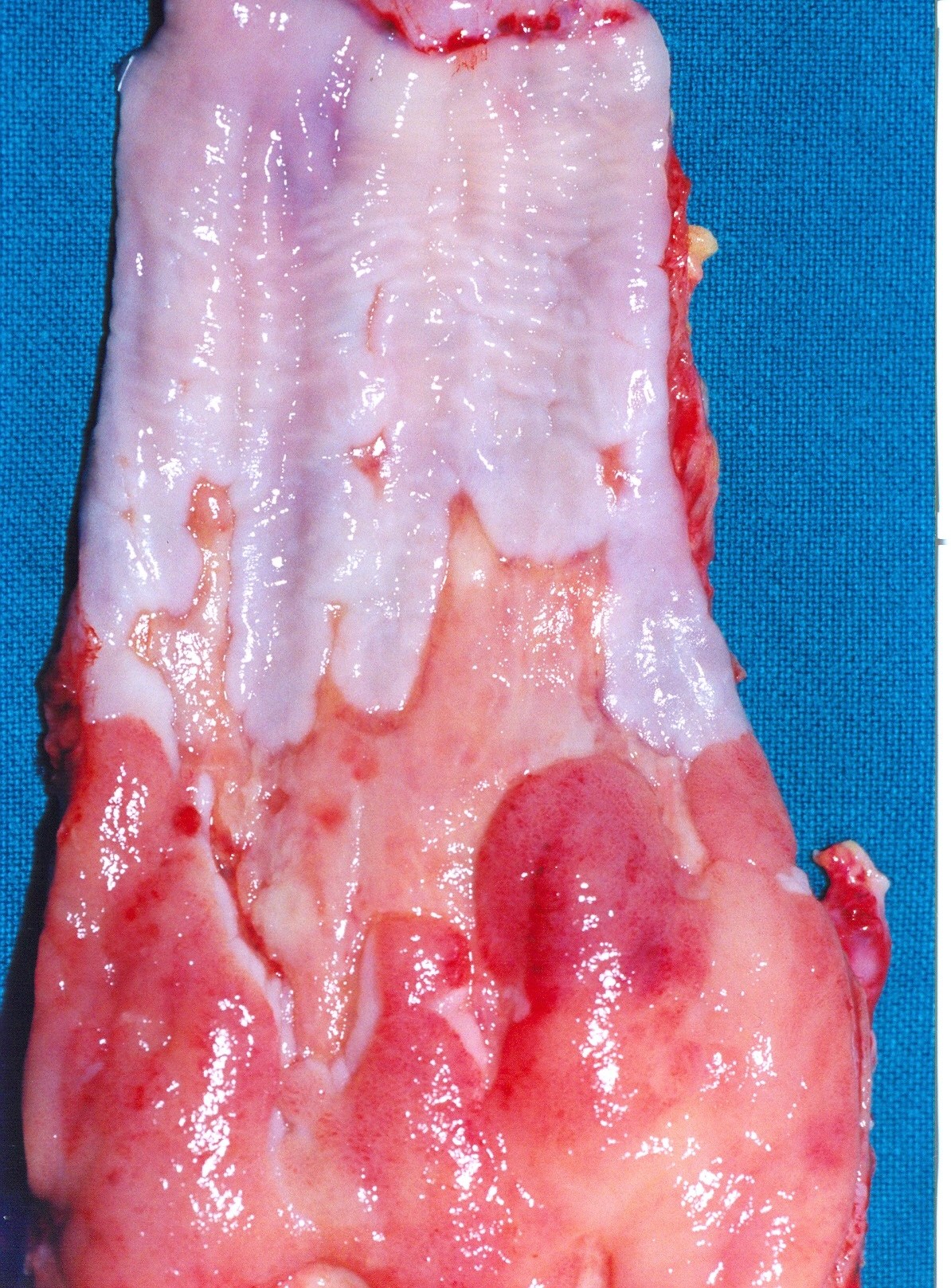ESOPHAGEAL CARCINOMA
