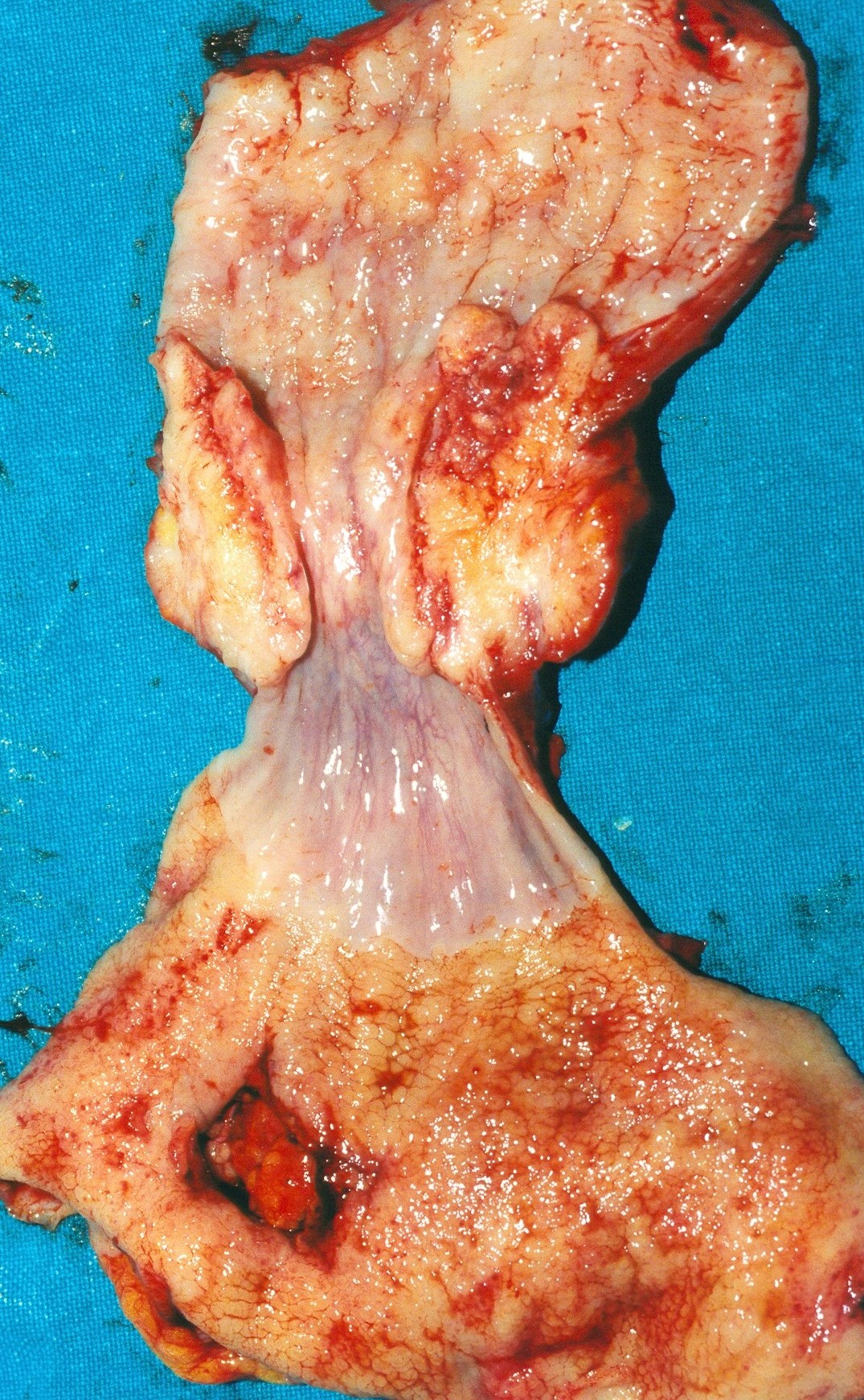 ESOPHAGEAL CARCINOMA