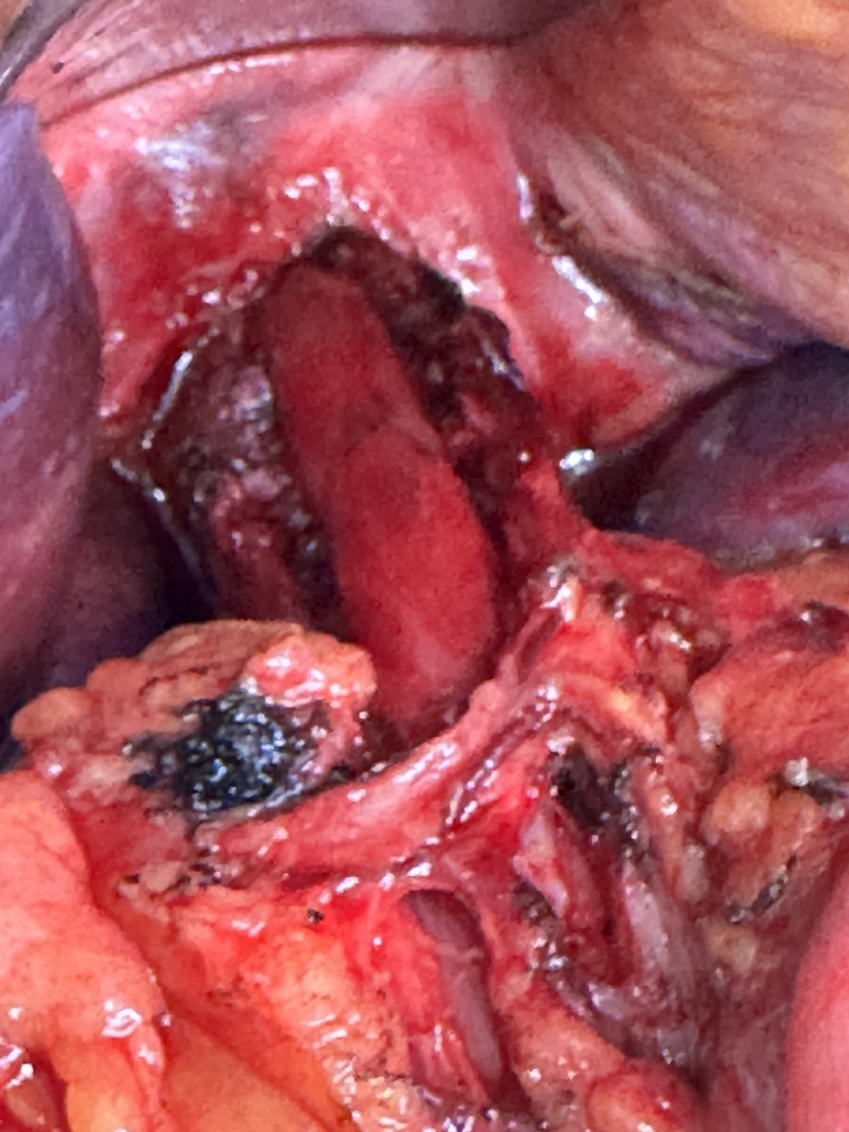 LONG HELLER'S ANTERIOR MYOTOMY