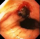 MALLORY - WEISS SYNDROME
