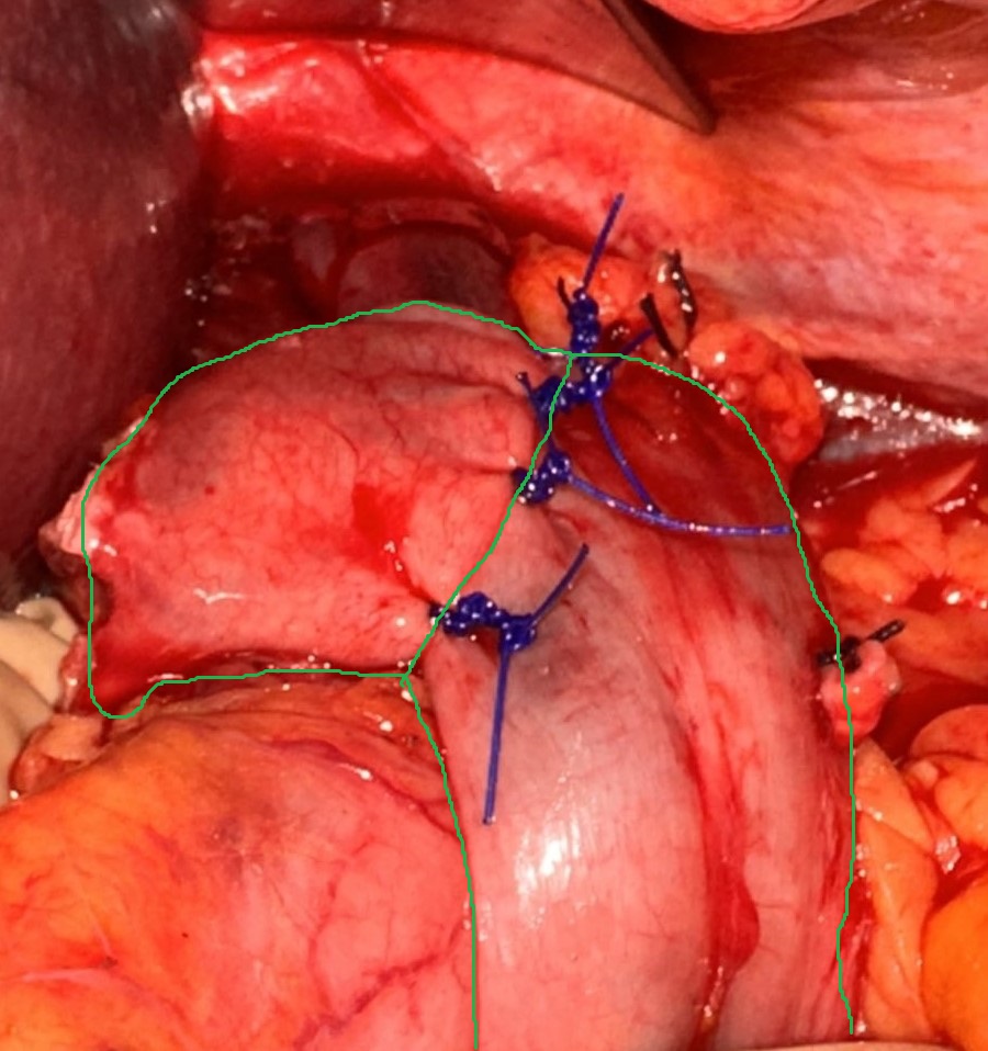 NISSEN'S FUNDOPLICATION