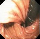 LOOSE NISSEN FUNDOPLICATION