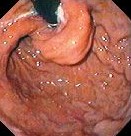 TIGHT NISSEN FUNDOPLICATION