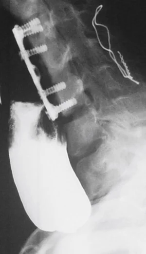 PHARYNGOESOPHAGEAL DIVERTICULUM