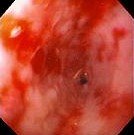 REFLUX ESOPHAGITIS