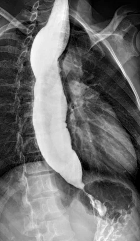 SCLERODERMA ESOPHAGUS