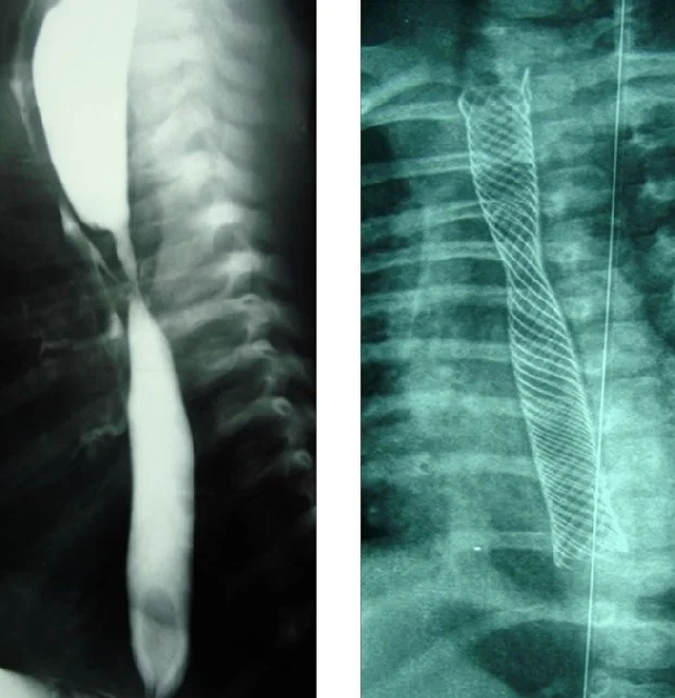 TRACHEO-ESOPHAGEAL FISTULA