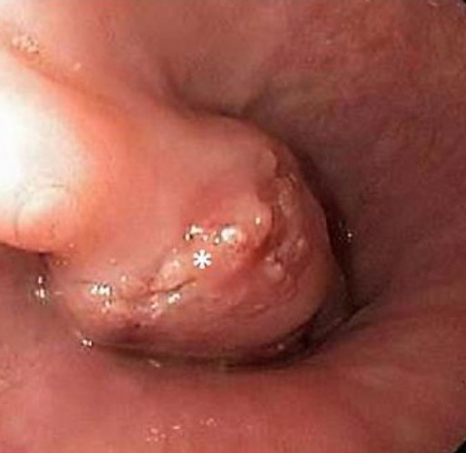 VERRUCOUS ESOPHAGEAL CARCINOMA