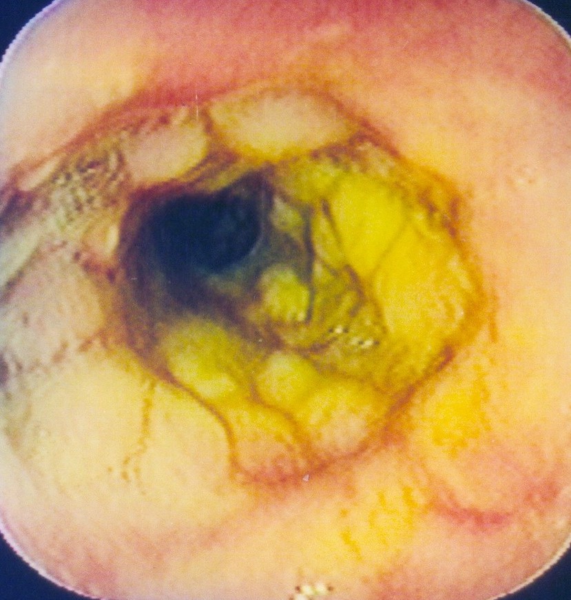 ESOPHAGOJEJUNAL ANASTOMOSIS