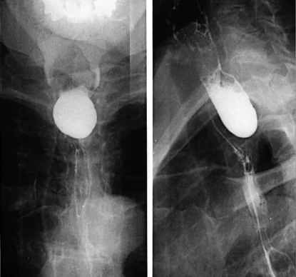 ZENKER'S DIVERTICULUM