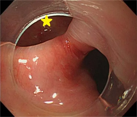 ZENKER'S DIVERTICULUM