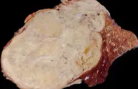 MALIGNANT SOLITARY FIBROUS TUMOR