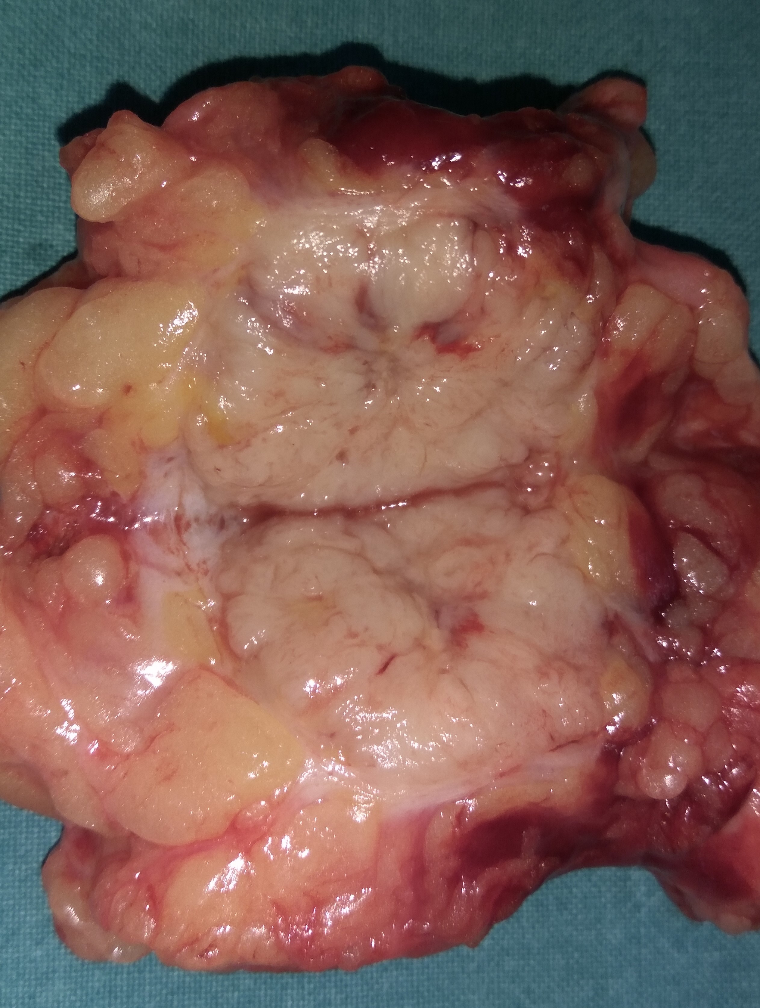 CHEST WALL METASTASIS
