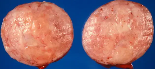 SOLITARY FIBROUS TUMOR