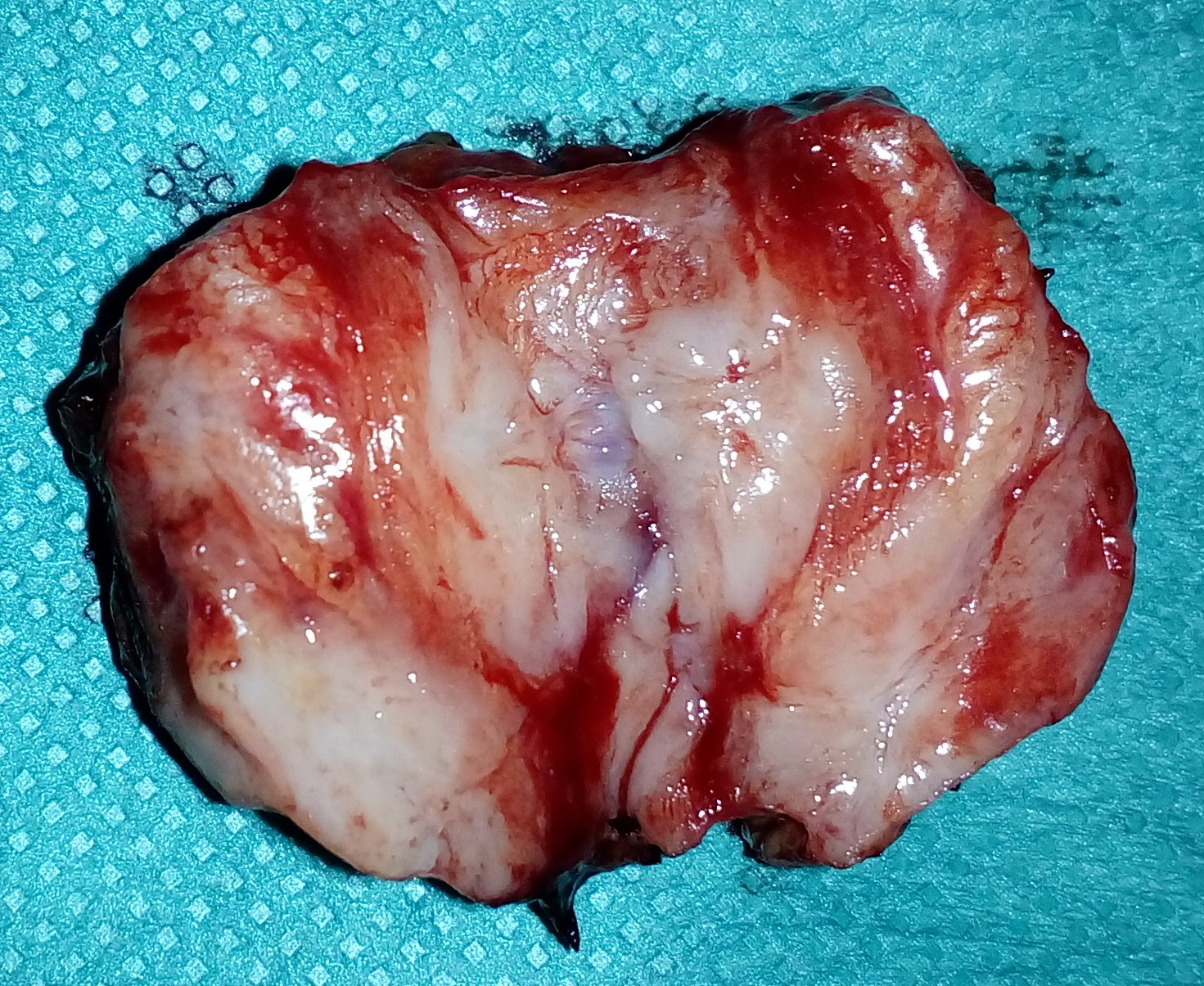 THORACIC MESOTHELIOMA