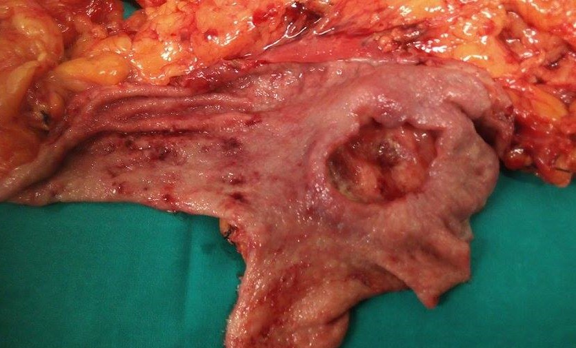 GASTRIC CARCINOMA