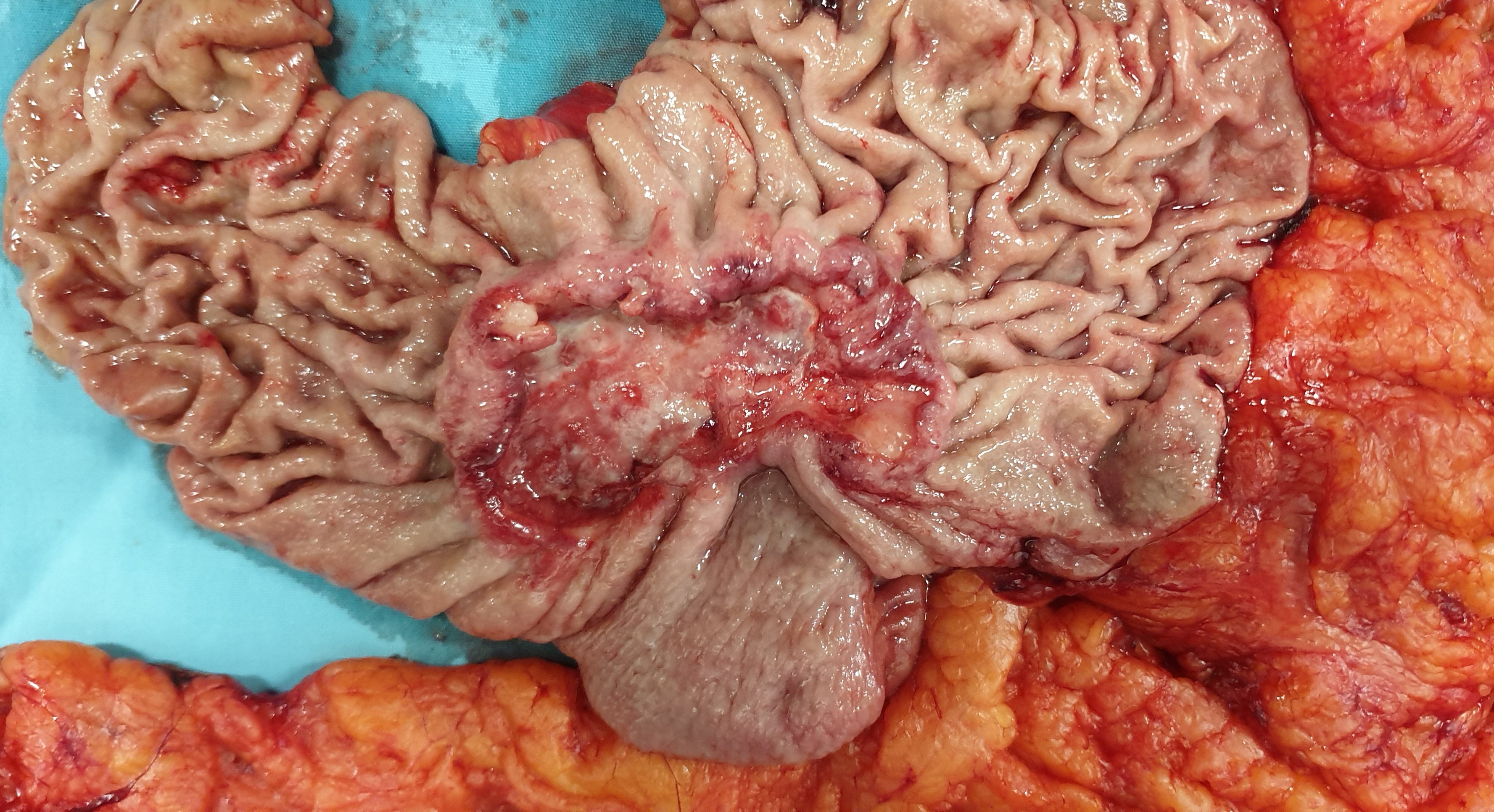 GASTRIC CARCINOMA