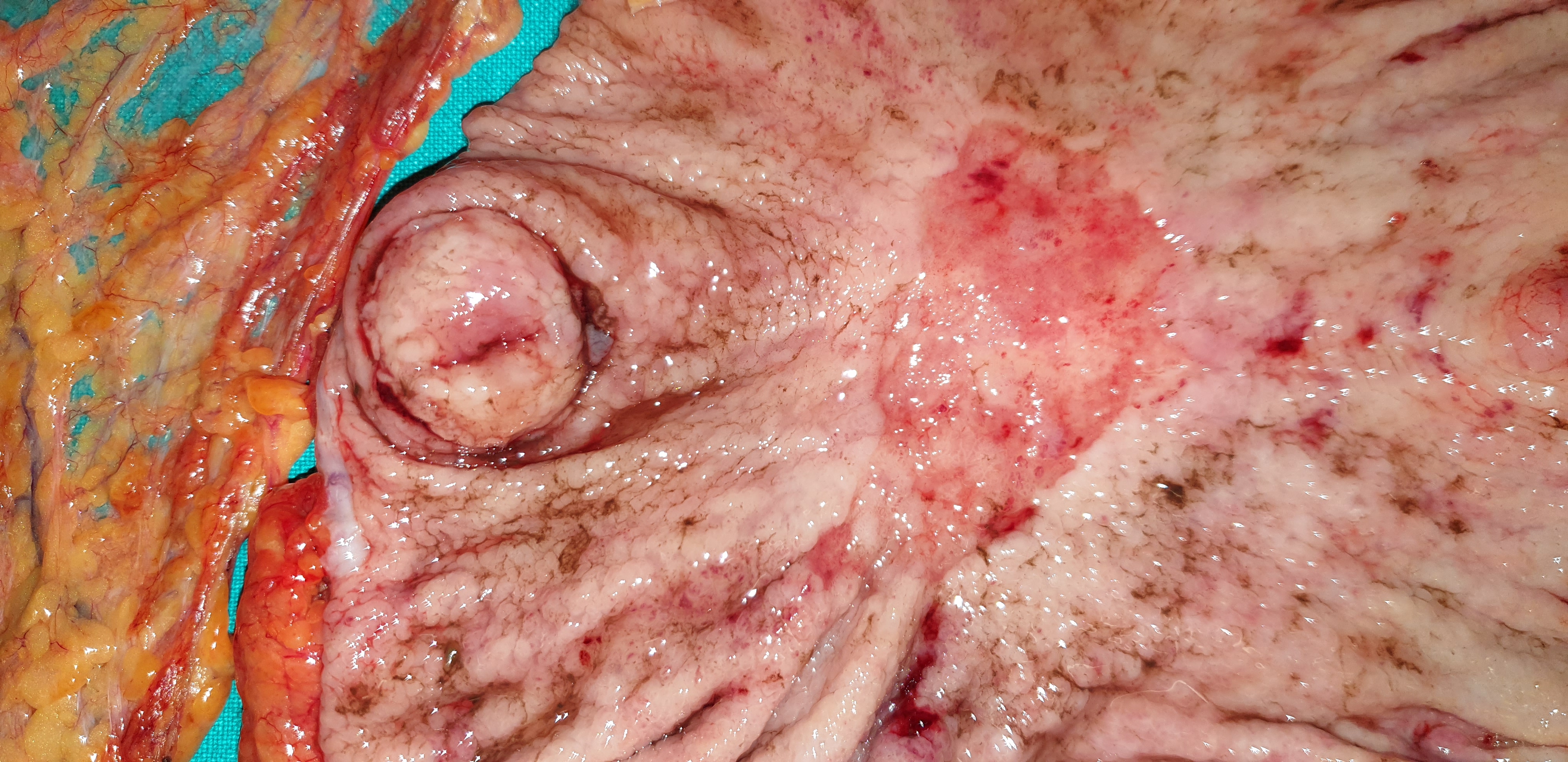 GASTRIC CARCINOMA