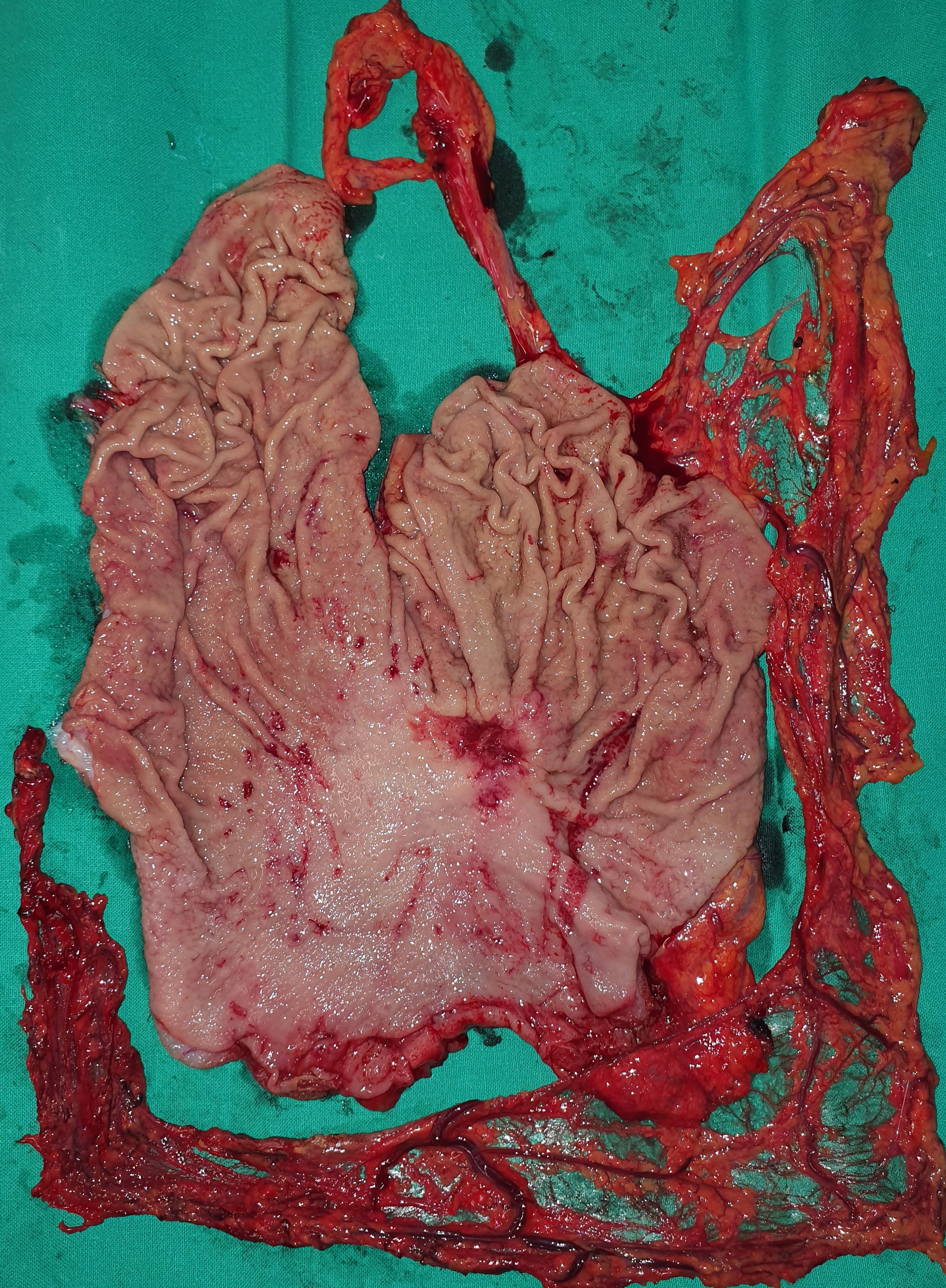 GASTRIC CARCINOMA