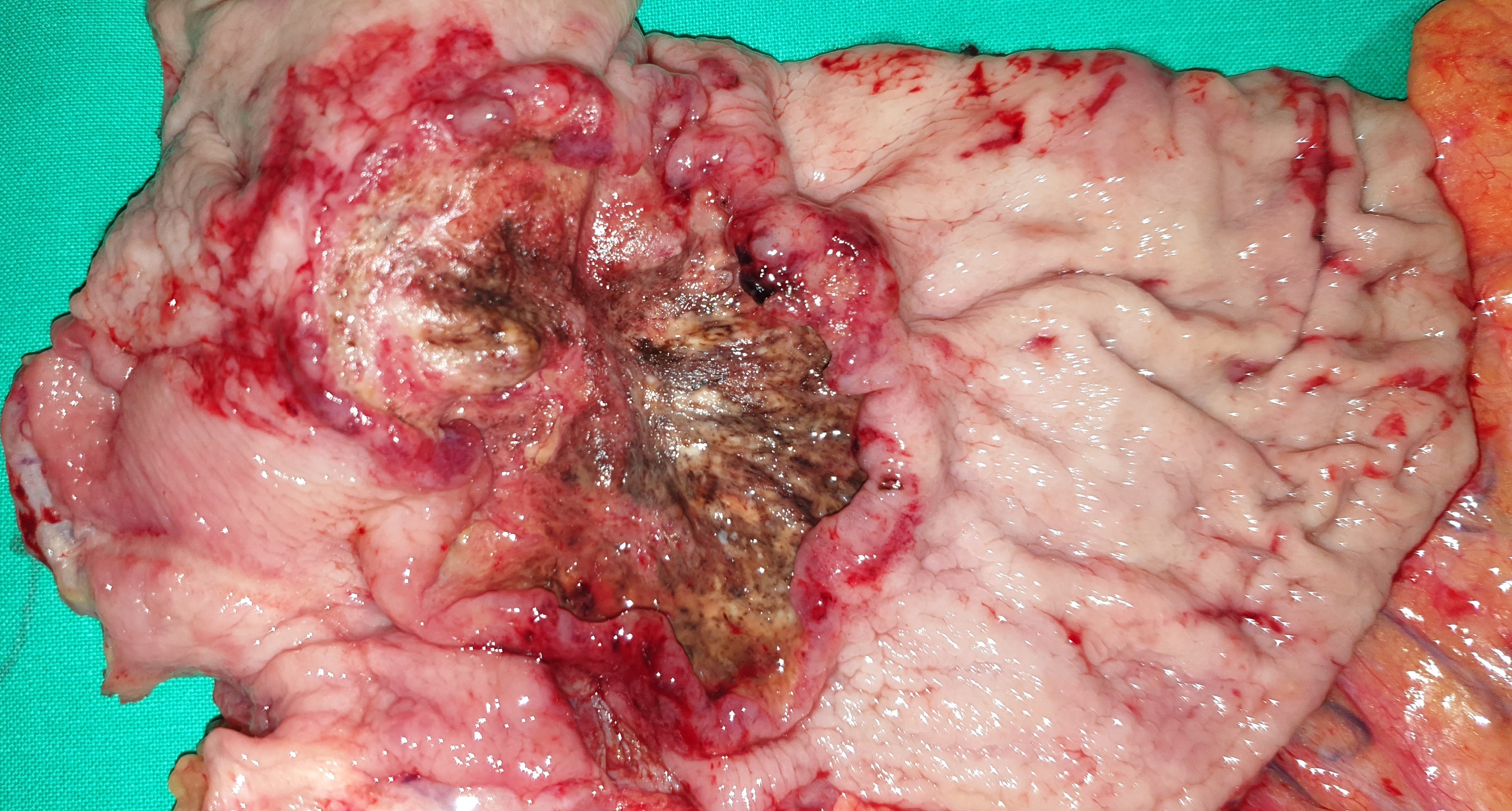GASTRIC CARCINOMA