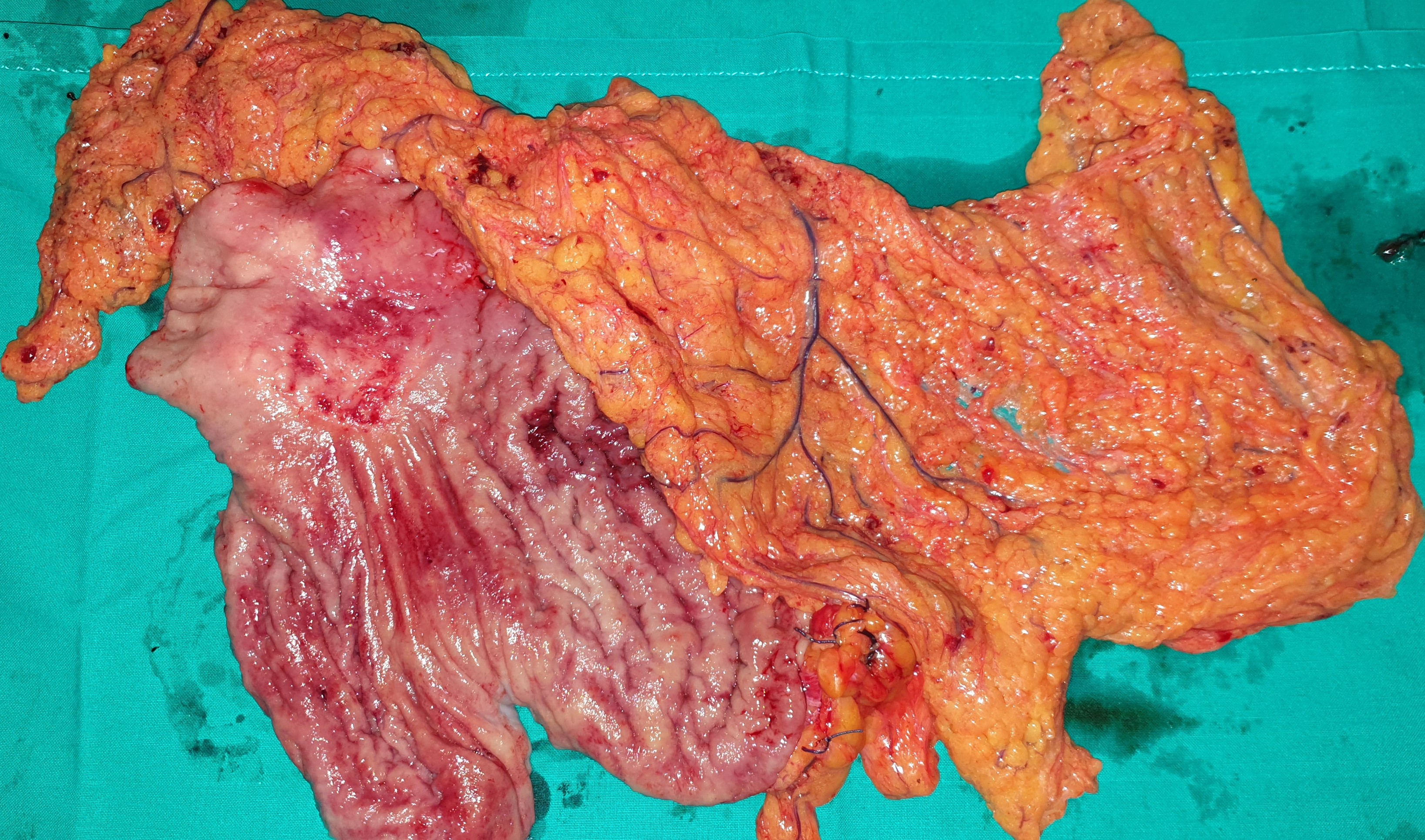 GASTRIC CARCINOMA