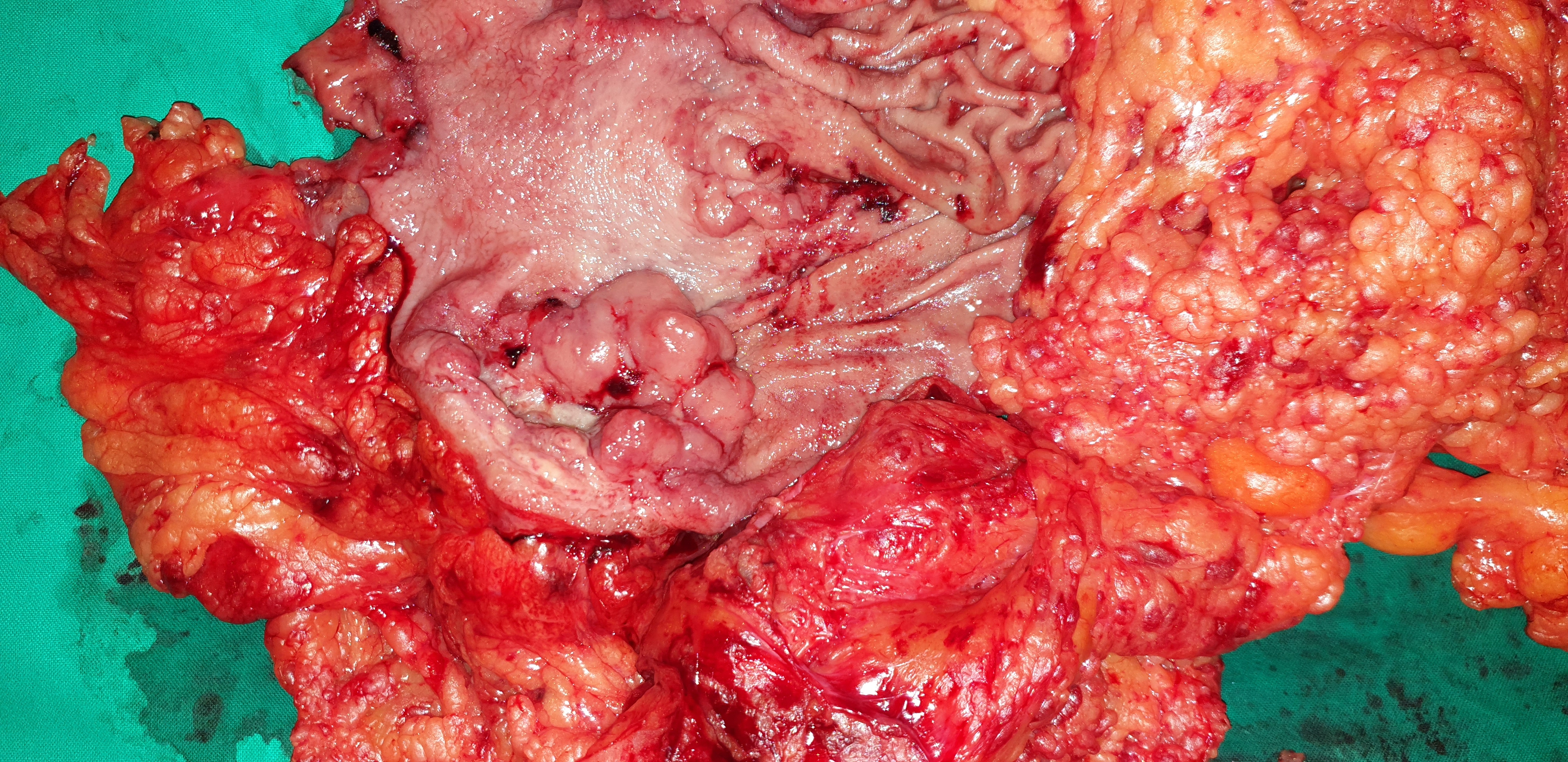 GASTRIC CARCINOMA