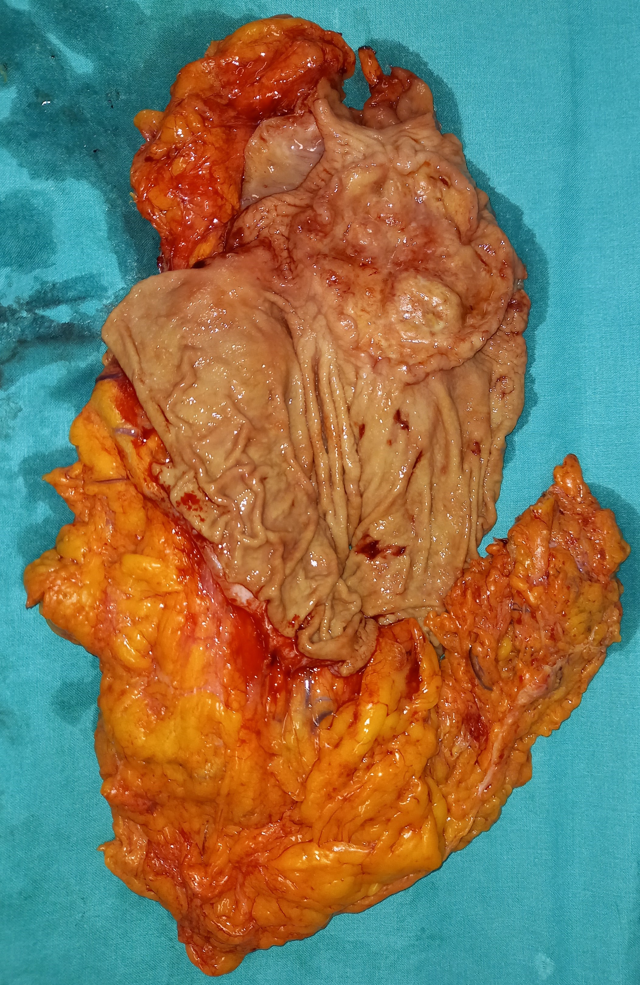 GASTRIC CARCINOMA