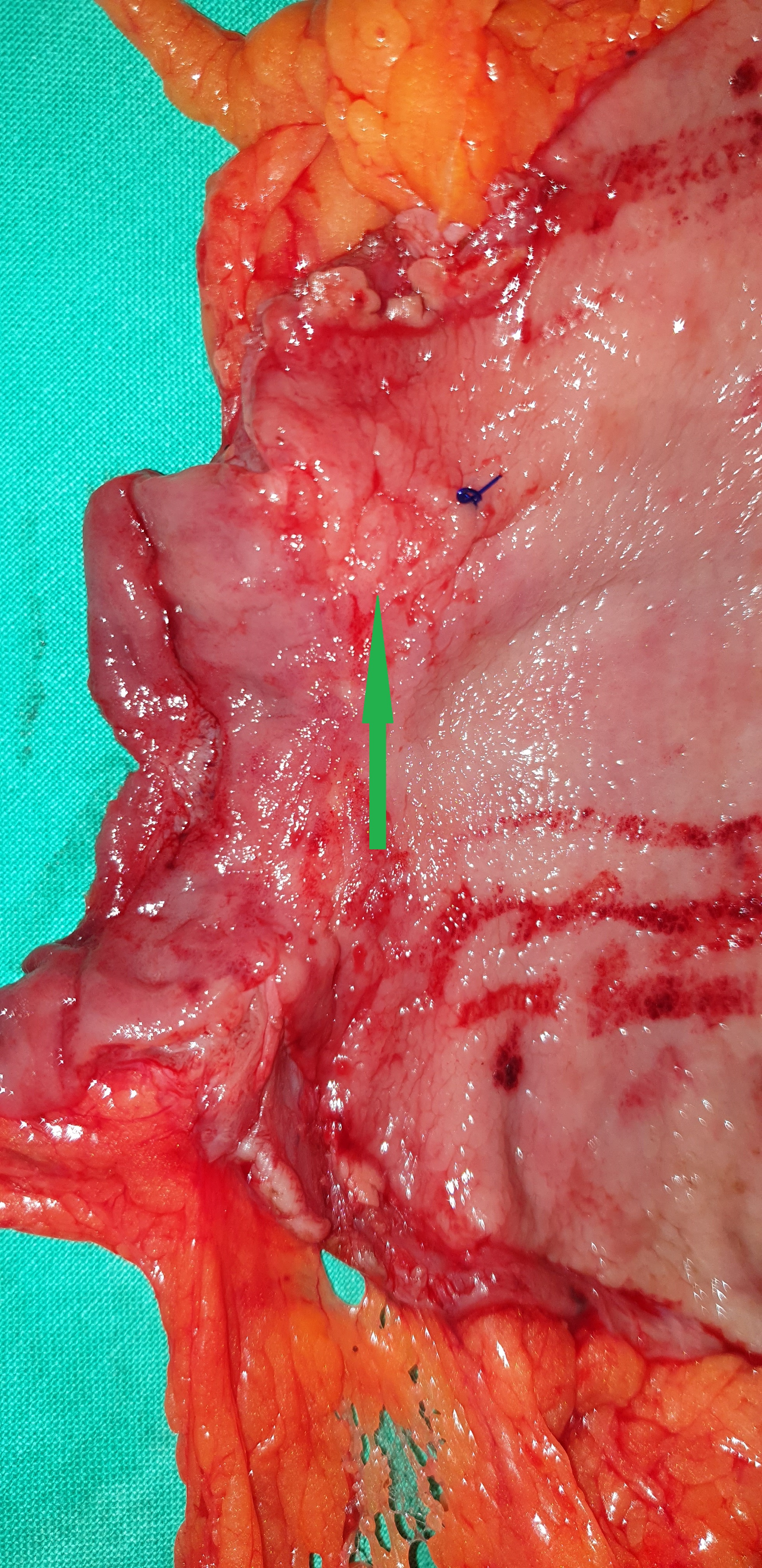 GASTRIC CARCINOMA