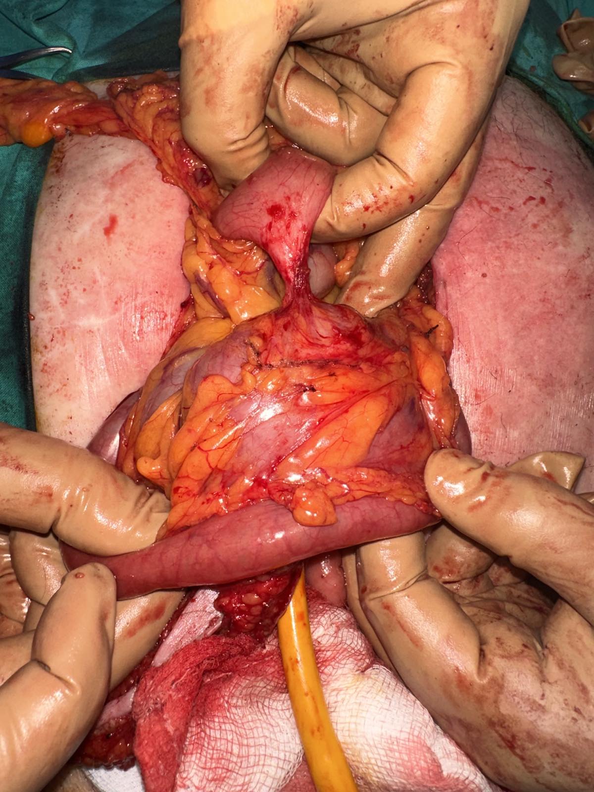 GASTROSTOMY FEEDING TUBE - GASTRO-COLIC FISTULA 