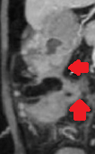 GASTRO-COLIC FISTULA