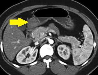 ECTOPIC GASTRIC PANCREAS