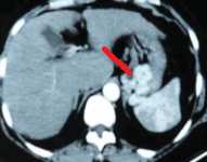 CAVERNOUS GASTRIC HEMANGIOMA