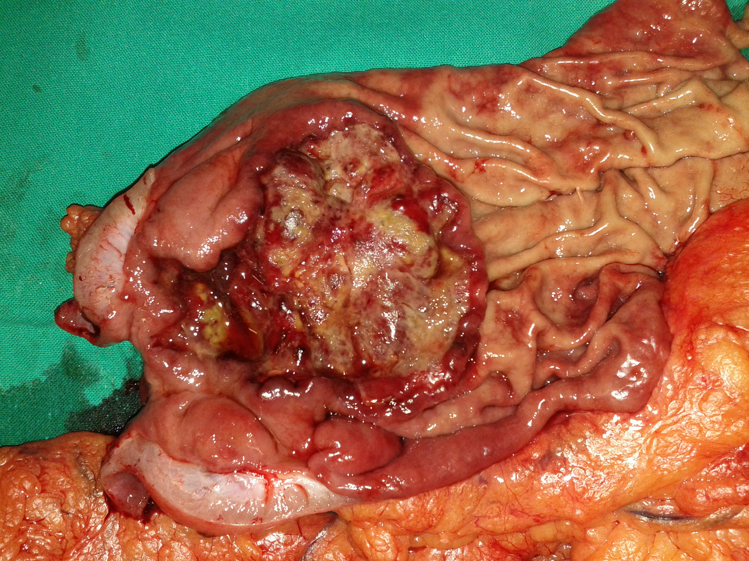 GASTRIC CANCER