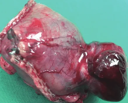 GASTRIC GIST
