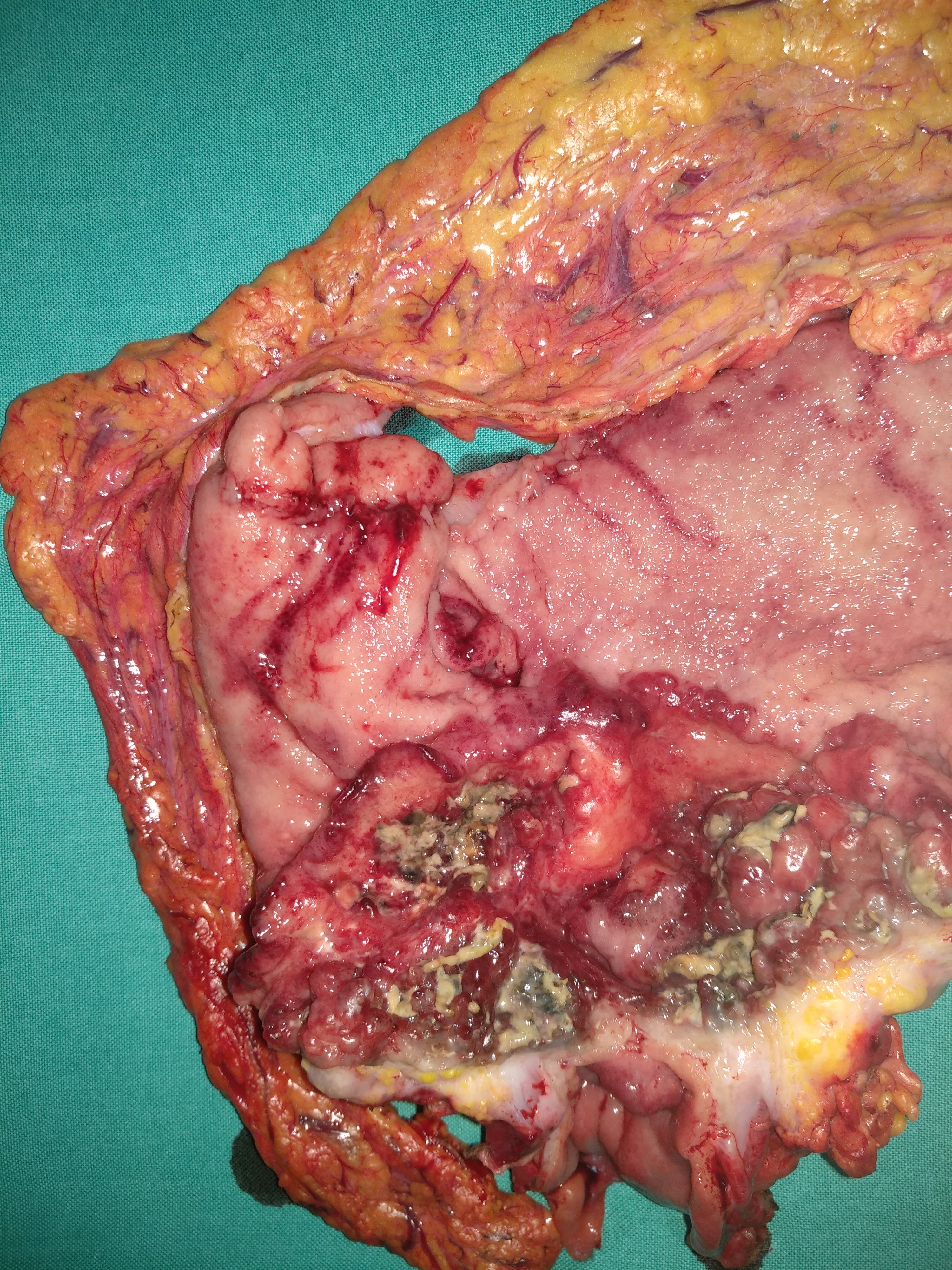GASTRIC CANCER