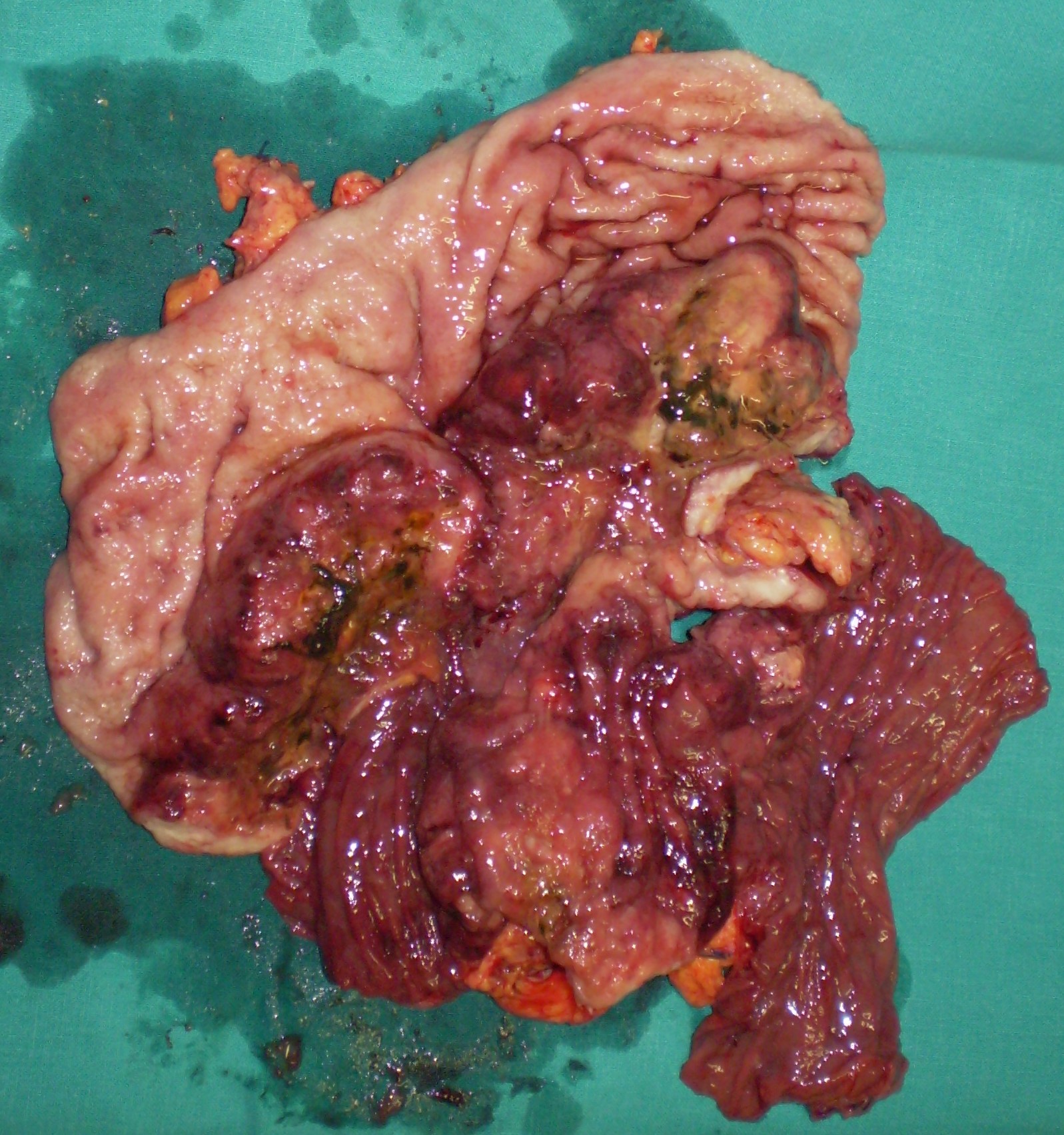 ANASTOMOTIC GASTRIC CANCER