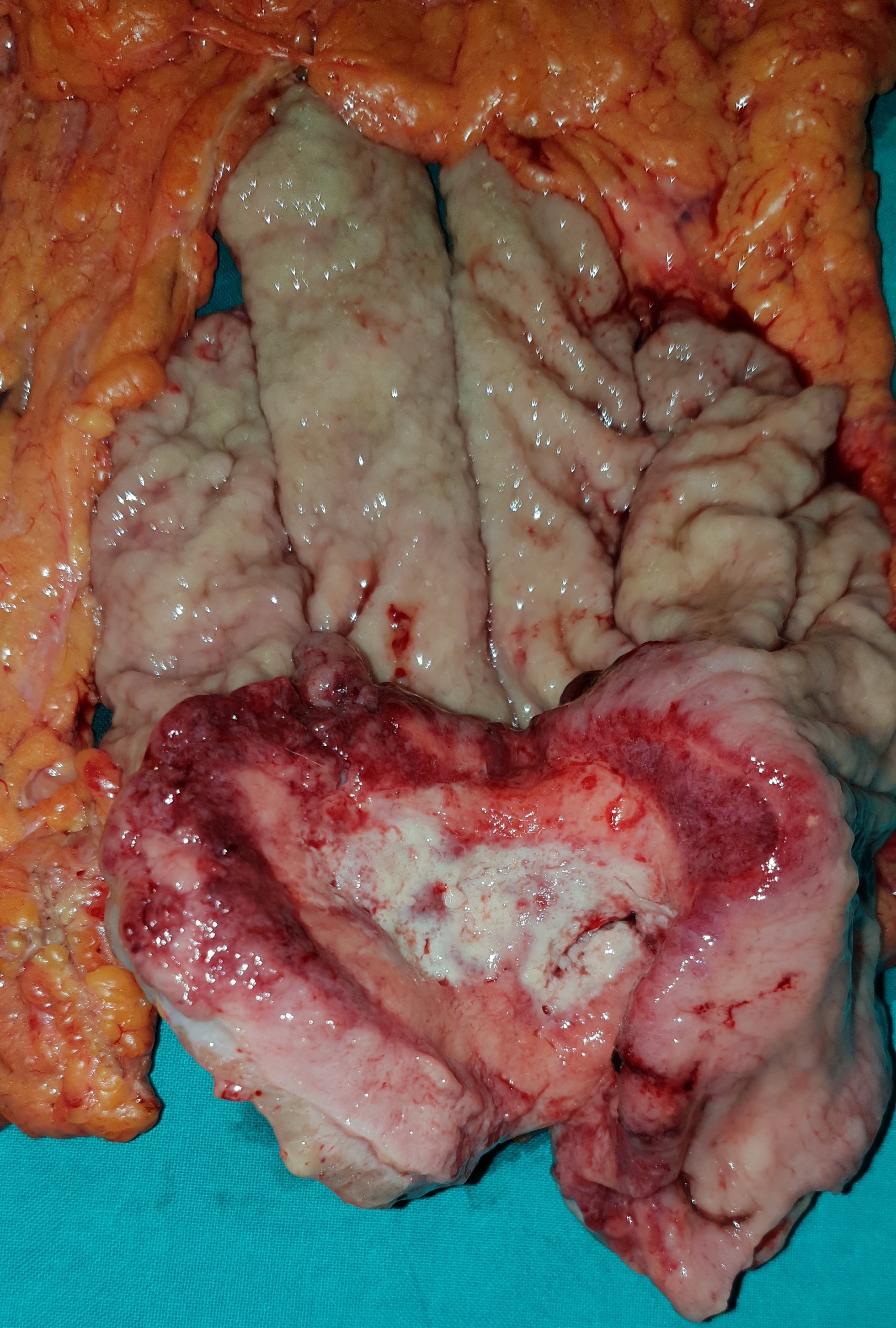 GASTRIC CANCER